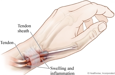 De Quervain’s Tenosynovitis