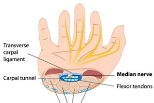 carpal tunnel syndrome