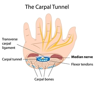 carpal tunnel syndrome