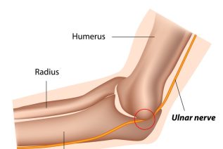 Cubital Tunnel Syndrome