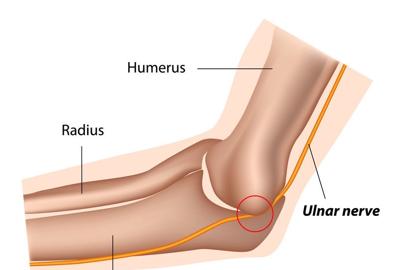 Cubital Tunnel Syndrome