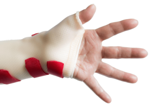 De Quervain’s Tenosynovitis Splinting