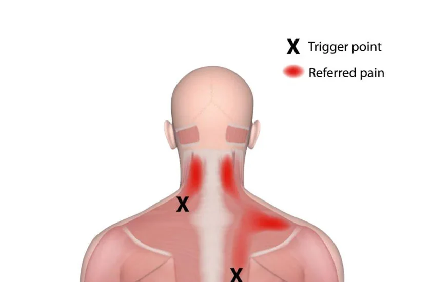 referred pain